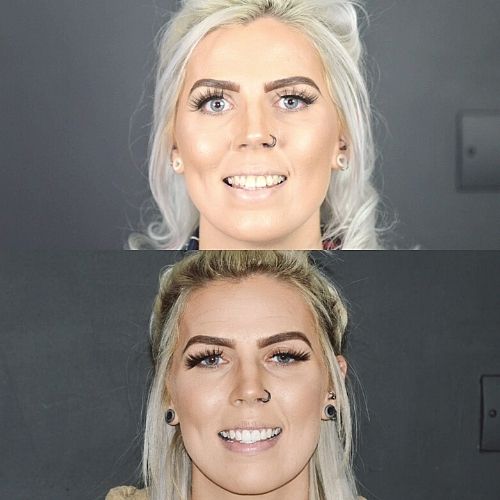 Before and after treatment at Cherrybank Dental Spa in Edinburgh 