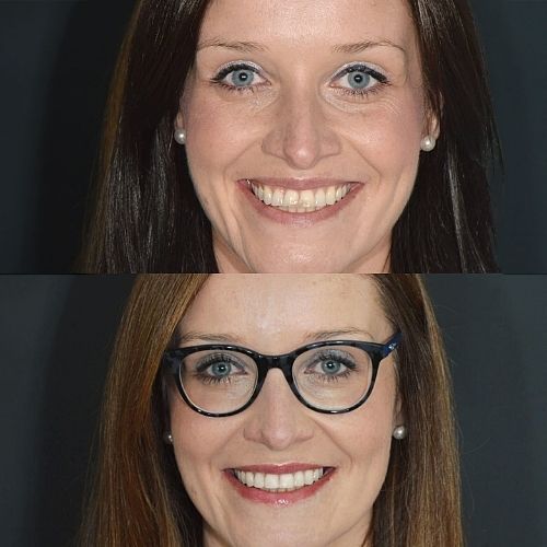 Before and after treatment at Cherrybank Dental Spa in Edinburgh 