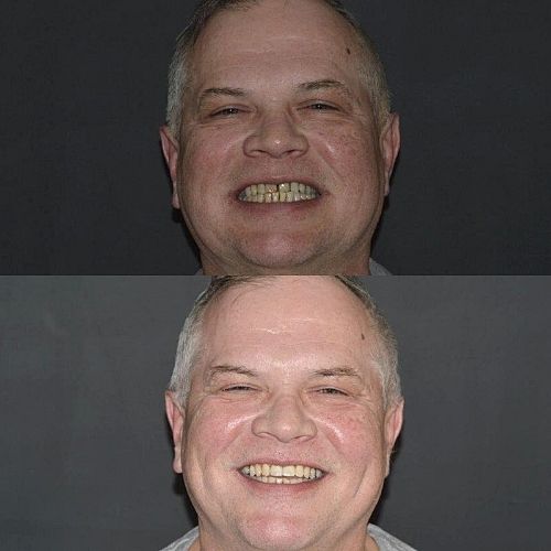 Before and after treatment at Cherrybank Dental Spa in Edinburgh 