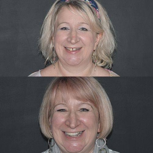 Before and after treatment at Cherrybank Dental Spa in Edinburgh 
