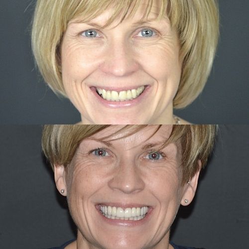 Before and after treatment at Cherrybank Dental Spa in Edinburgh 