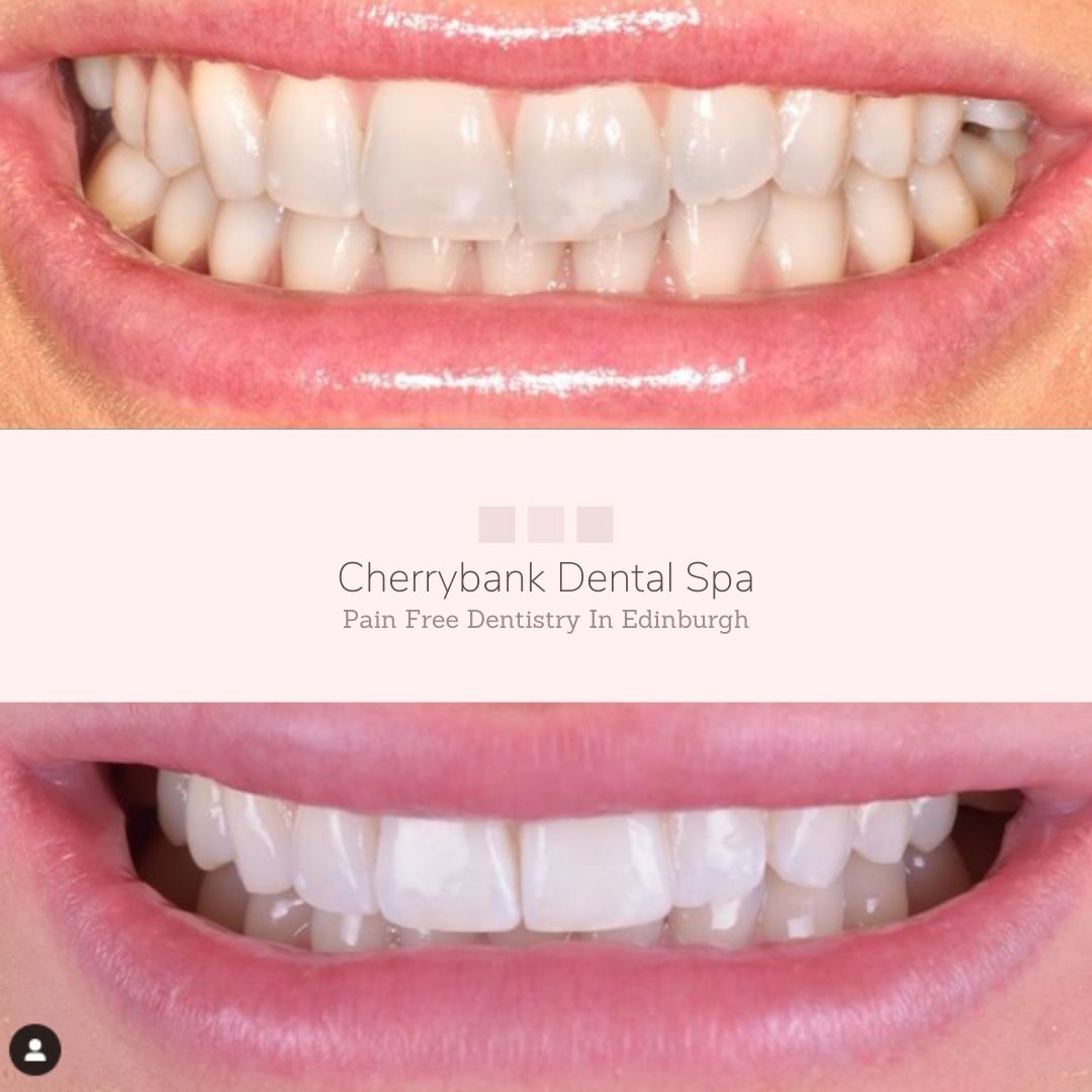 Straight Teeth at Cherrybank Edinburgh | Cherrybank Dental Spa Edinburgh Before and after treatment at Cherrybank Dental Spa in Edinburgh