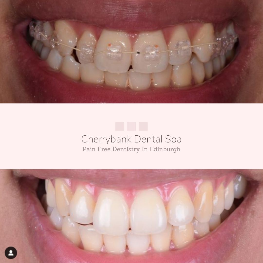 Straight Teeth at Cherrybank Edinburgh | Cherrybank Dental Spa Edinburgh Before and after treatment at Cherrybank Dental Spa in Edinburgh