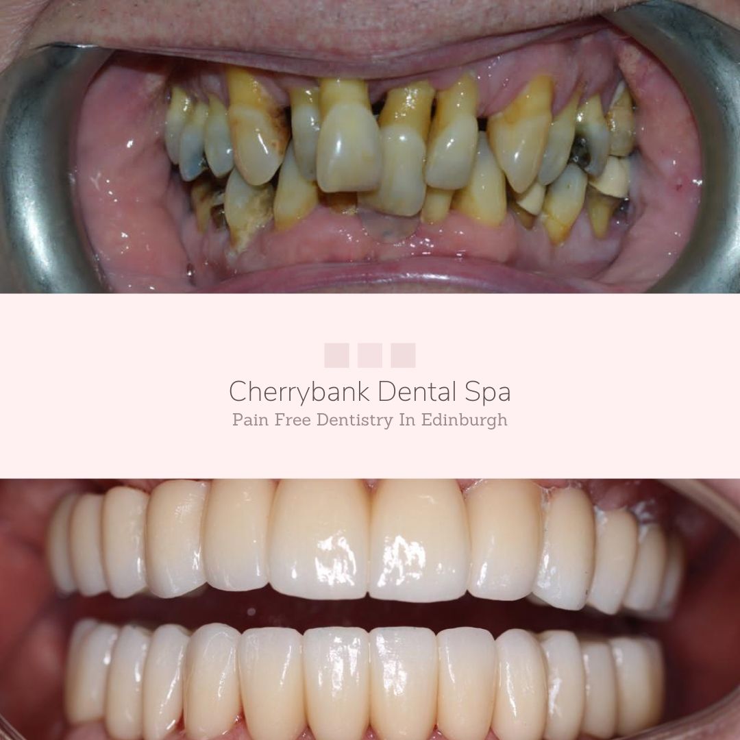 Before and after treatment at Cherrybank Dental Spa in Edinburgh 