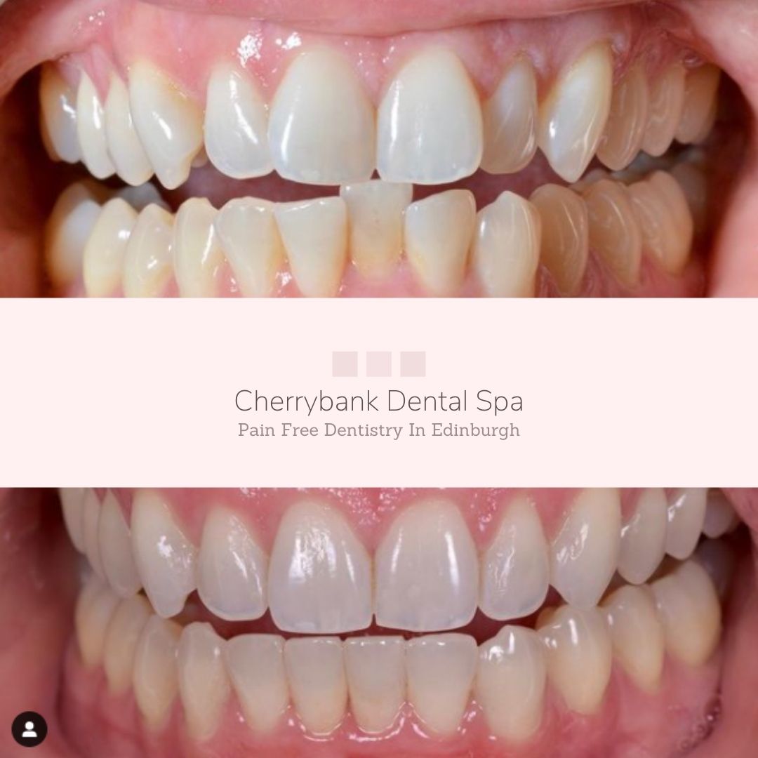 Straight Teeth at Cherrybank Edinburgh | Cherrybank Dental Spa Edinburgh Before and after treatment at Cherrybank Dental Spa in Edinburgh