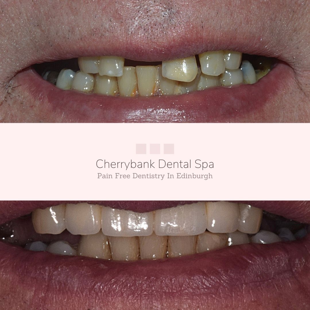 Before and after treatment at Cherrybank Dental Spa in Edinburgh 