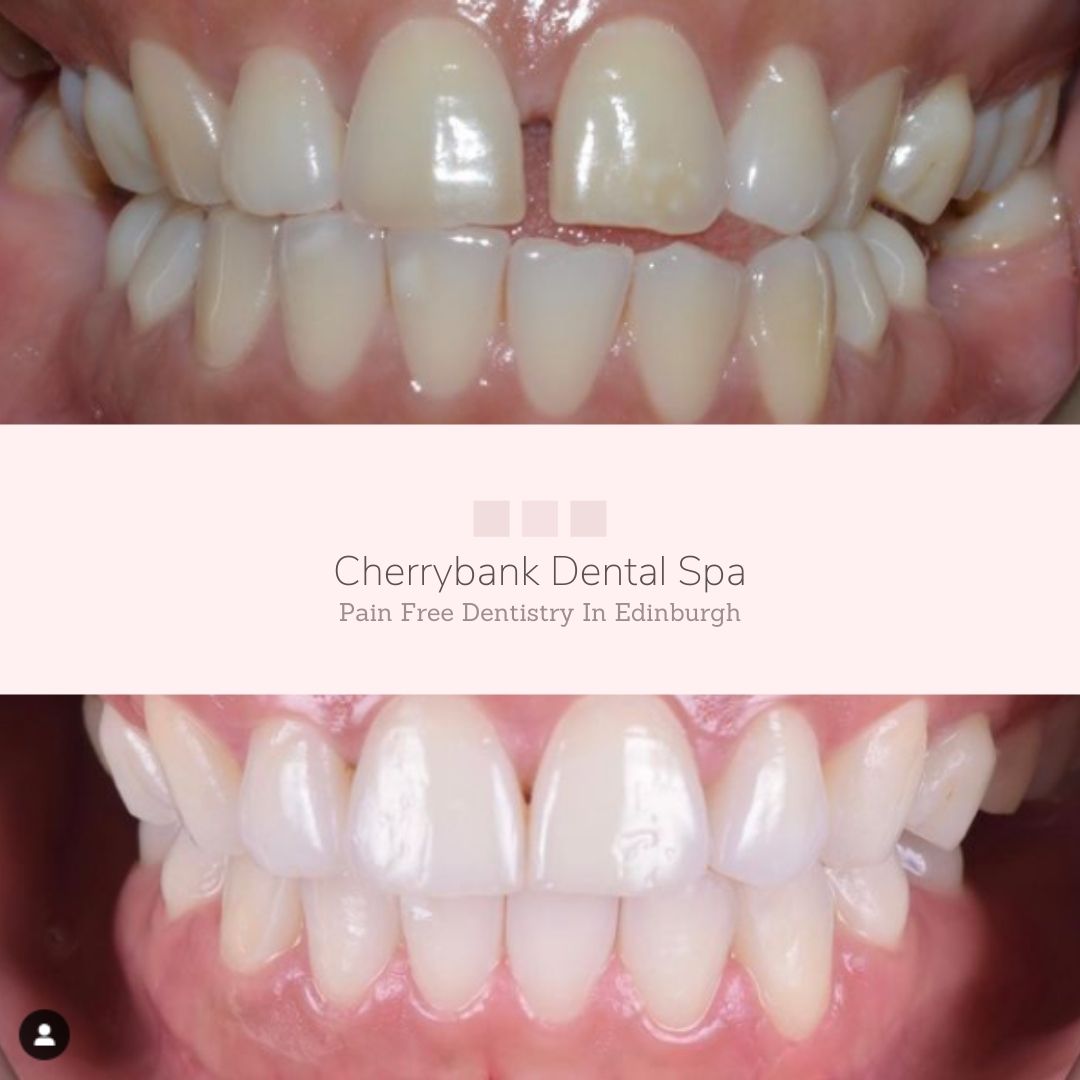 Straight Teeth at Cherrybank Edinburgh | Cherrybank Dental Spa Edinburgh Before and after treatment at Cherrybank Dental Spa in Edinburgh