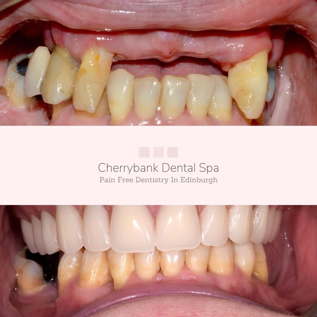 Before and after treatment at Cherrybank Dental Spa in Edinburgh 