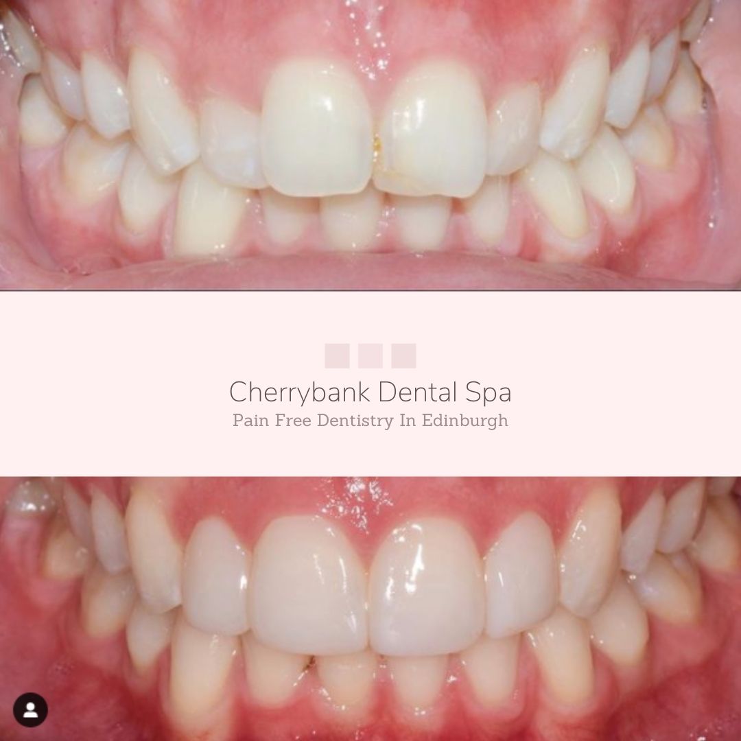 Straight Teeth at Cherrybank Edinburgh | Cherrybank Dental Spa Edinburgh Before and after treatment at Cherrybank Dental Spa in Edinburgh