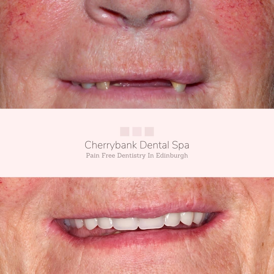 Before and after treatment at Cherrybank Dental Spa in Edinburgh 