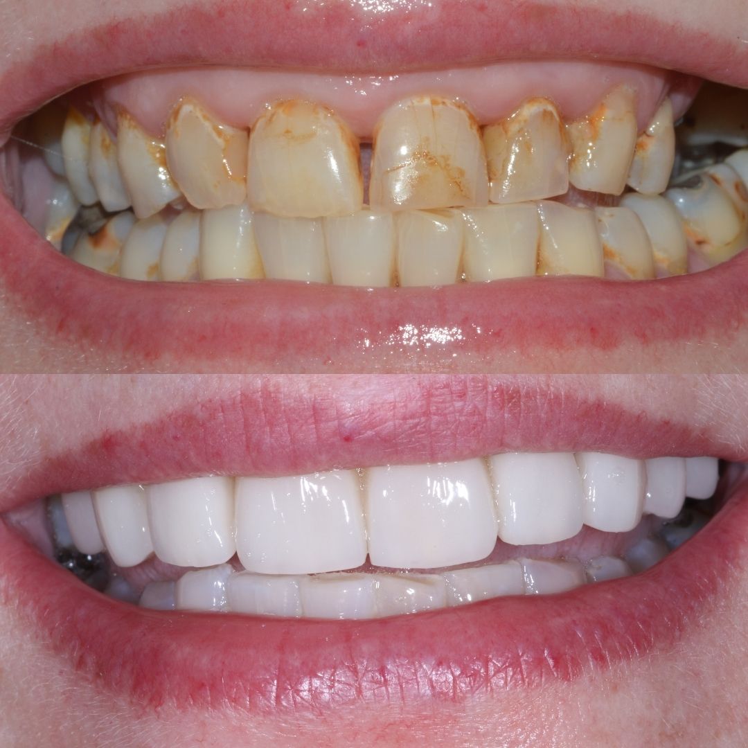 Before and after treatment at Cherrybank Dental Spa