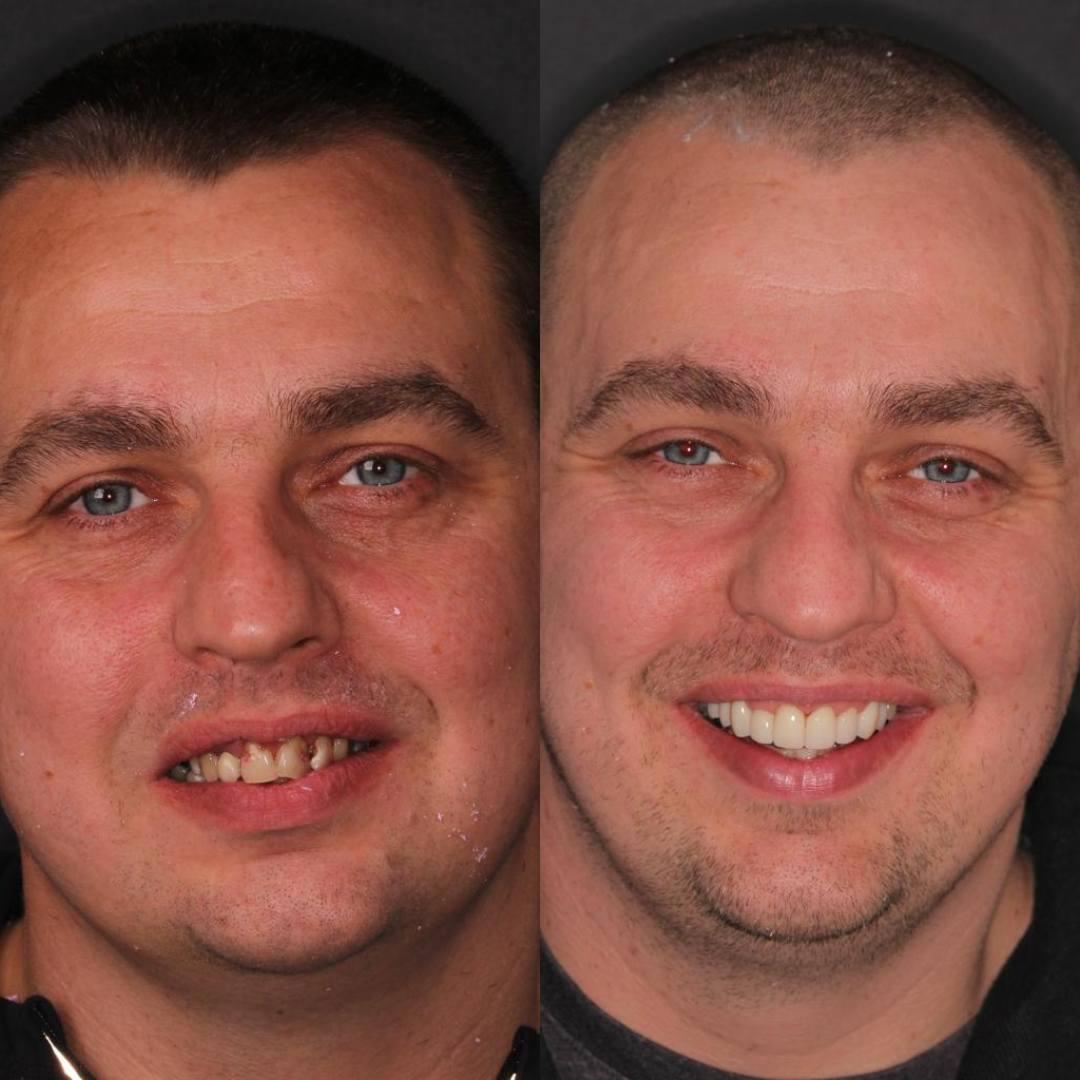 Porcelain Veneers | Cherrybank Dental Spa Edinburgh