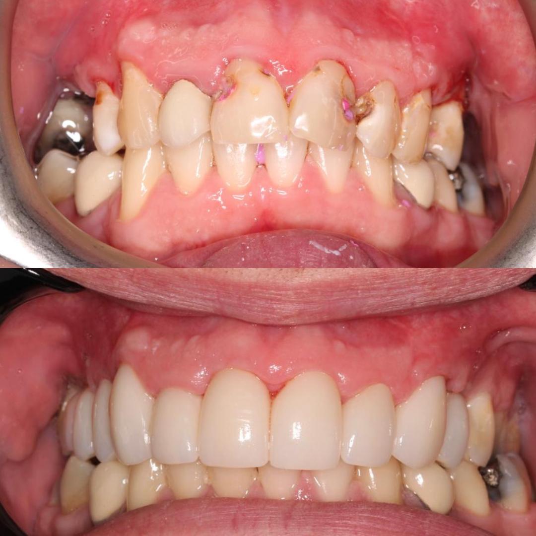 Porcelain Veneers | Cherrybank Dental Spa Edinburgh
