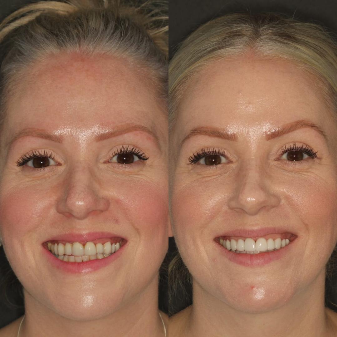 Porcelain Veneers | Cherrybank Dental Spa Edinburgh