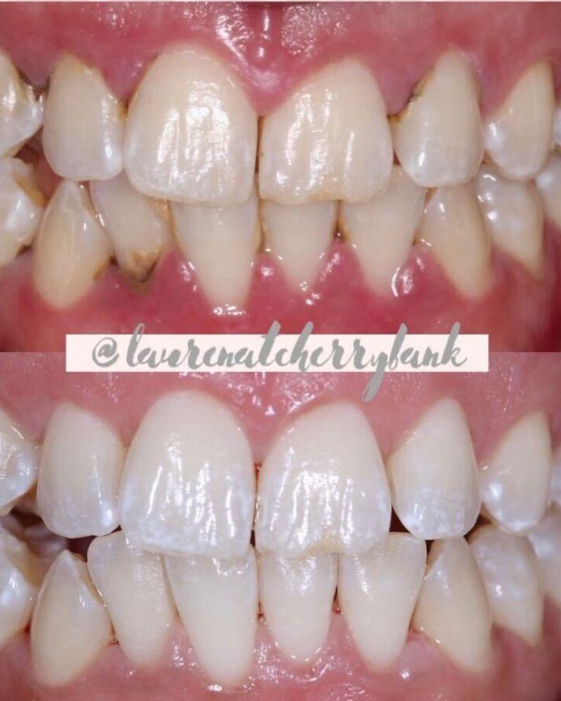 Before & after treatment with Lauren