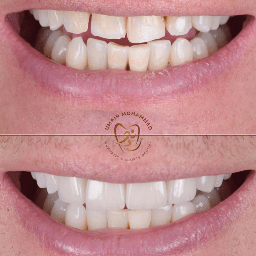 Before & after treatment with Umair