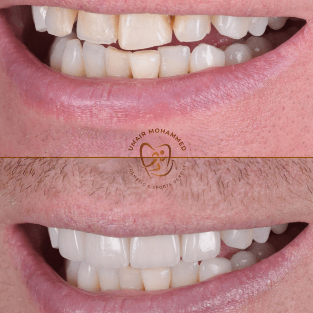 Before & after treatment with Umair