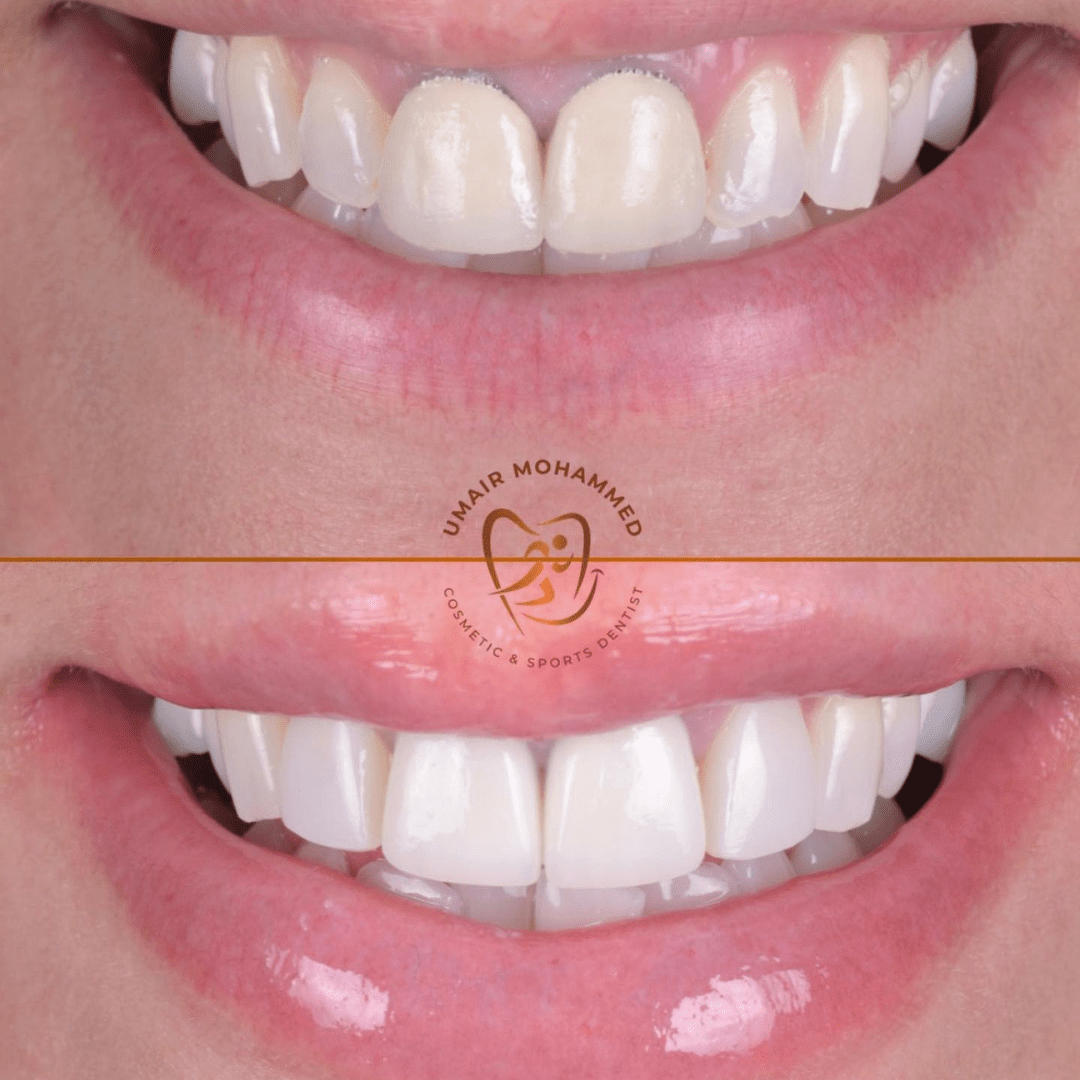 Before & after treatment with Umair