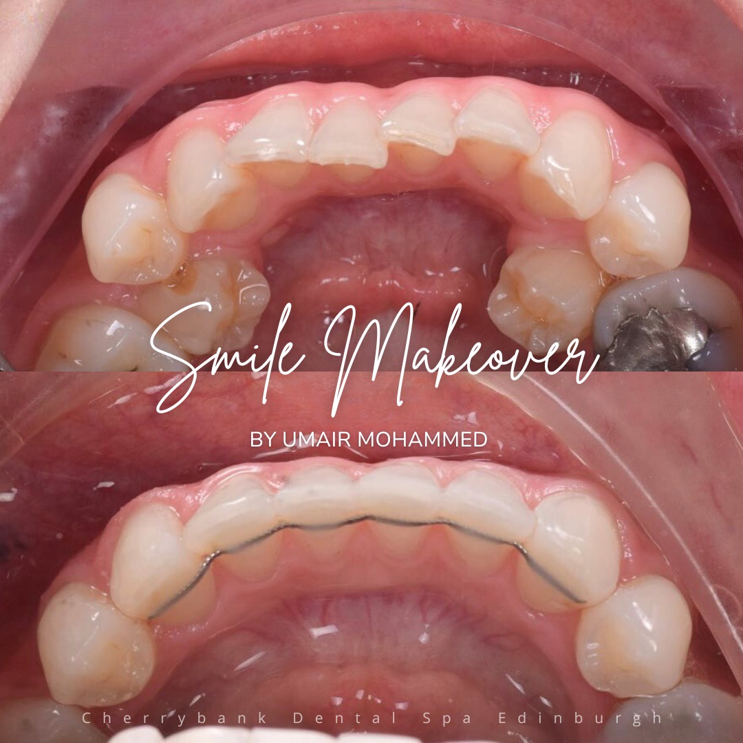 Straight Teeth at Cherrybank Edinburgh | Cherrybank Dental Spa Edinburgh Straight Teeth at Cherrybank Edinburgh | Cherrybank Dental Spa Edinburgh