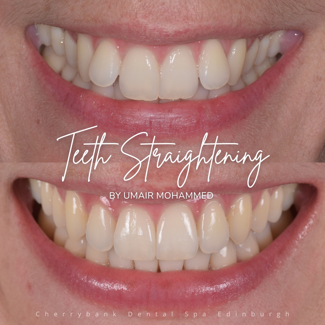 Straight Teeth at Cherrybank Edinburgh | Cherrybank Dental Spa Edinburgh Straight Teeth at Cherrybank Edinburgh | Cherrybank Dental Spa Edinburgh