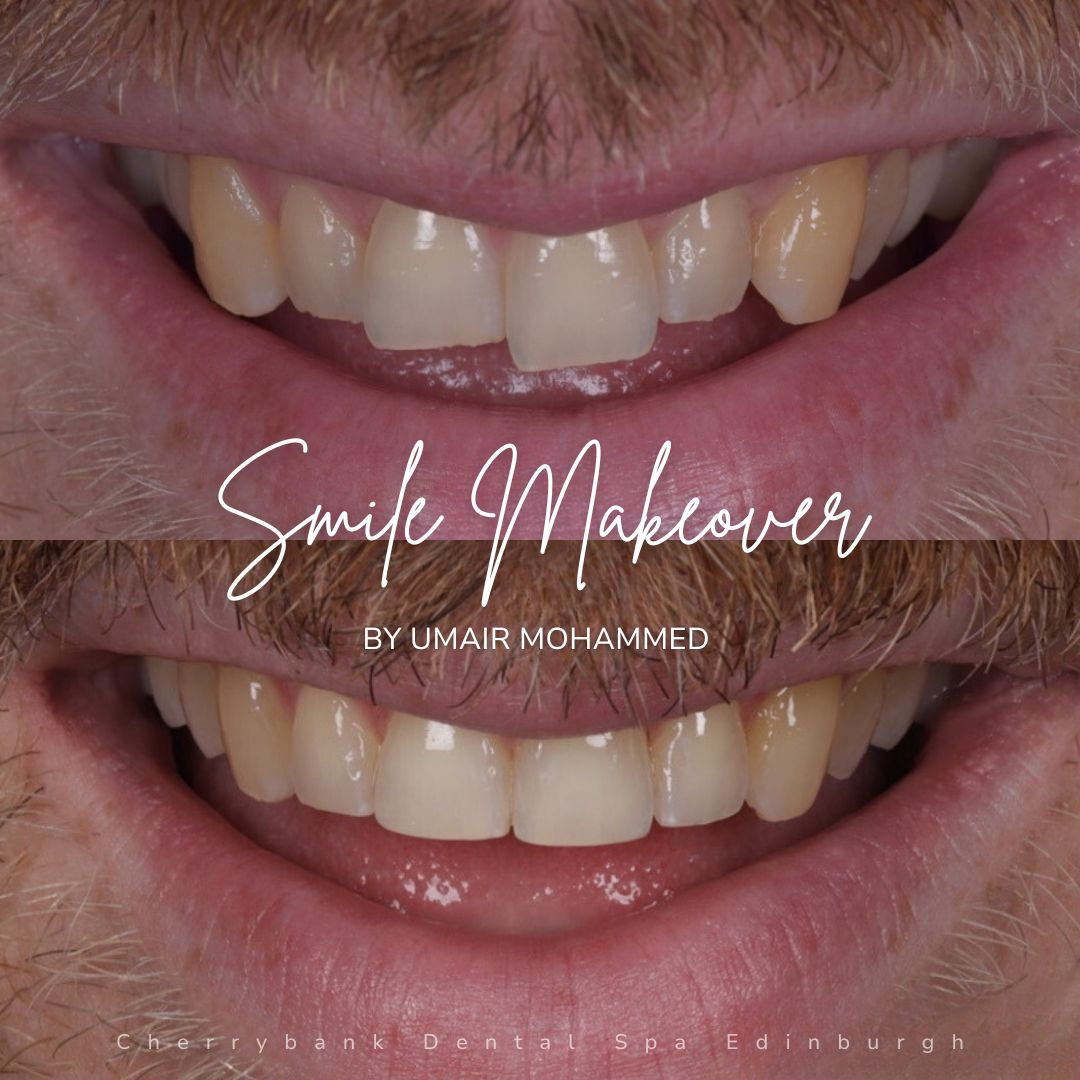 Smile Makeovers in Edinburgh | Cherrybank Dental Spa Edinburgh Smile Makeovers in Edinburgh | Cherrybank Dental Spa Edinburgh