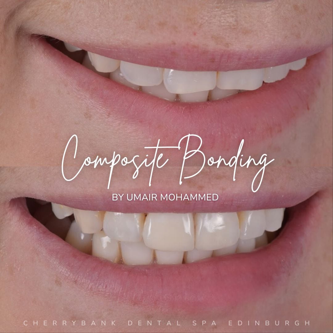 Teeth Whitening in Edinburgh