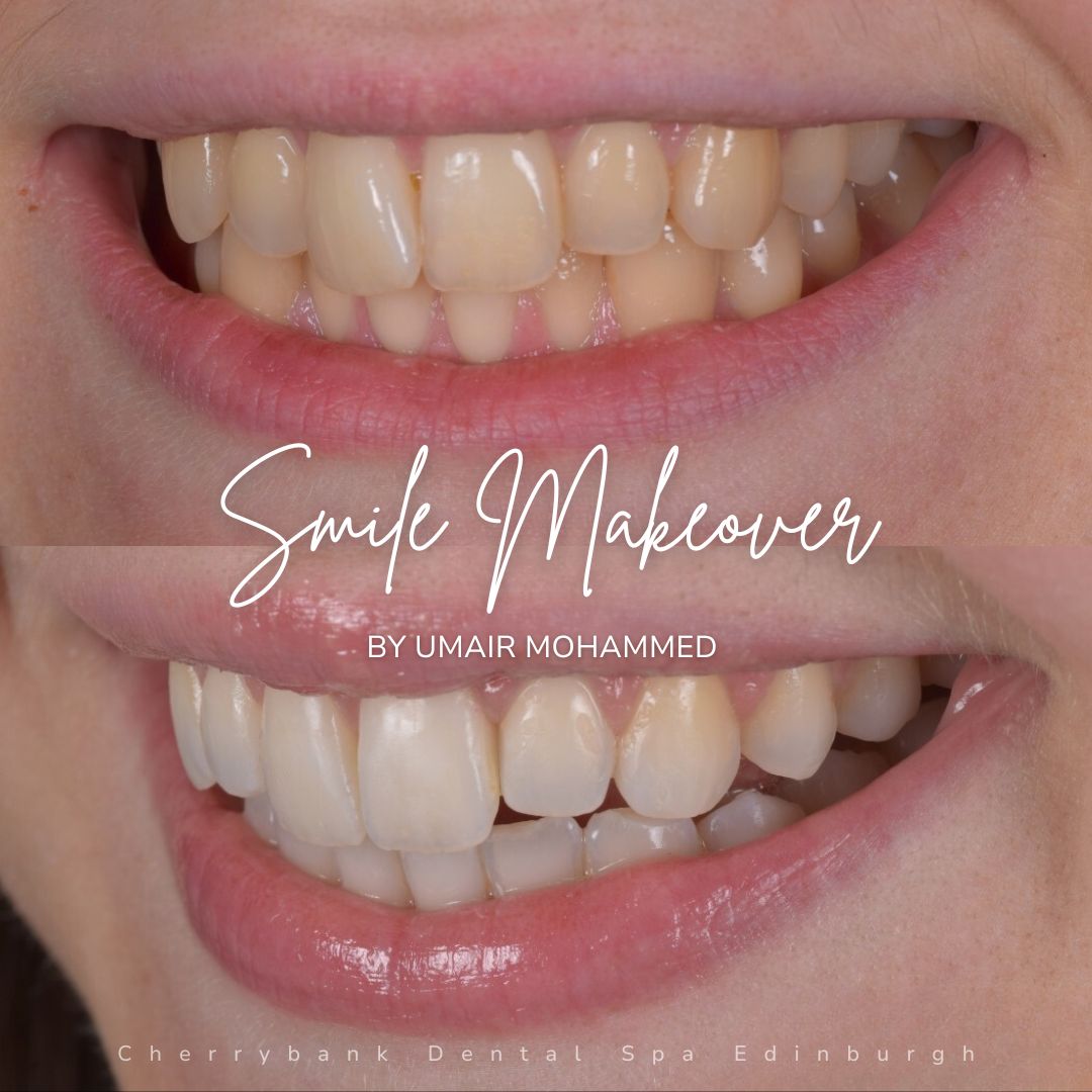 Smile Makeovers in Edinburgh | Cherrybank Dental Spa Edinburgh Smile Makeovers in Edinburgh | Cherrybank Dental Spa Edinburgh