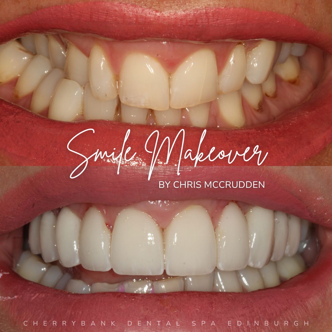 Smile Makeovers in Edinburgh | Cherrybank Dental Spa Edinburgh Smile Makeovers in Edinburgh | Cherrybank Dental Spa Edinburgh