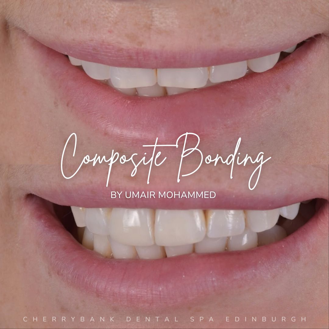 Smile Makeovers in Edinburgh | Cherrybank Dental Spa Edinburgh Before and after treatment at Cherrybank Dental Spa