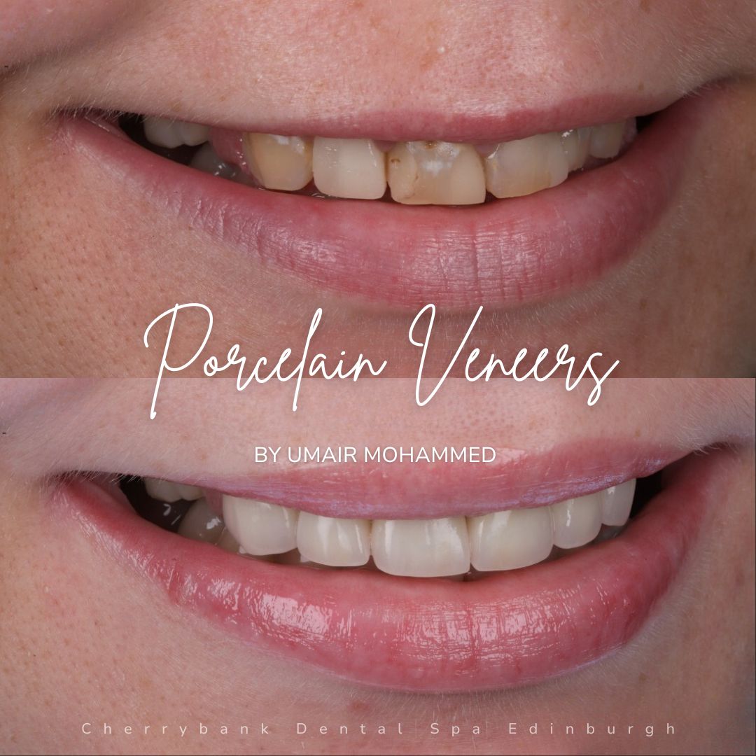 Porcelain Veneers | Cherrybank Dental Spa Edinburgh