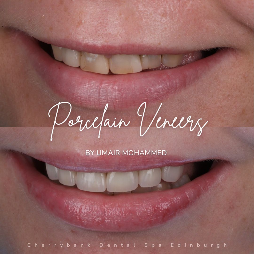Porcelain Veneers | Cherrybank Dental Spa Edinburgh