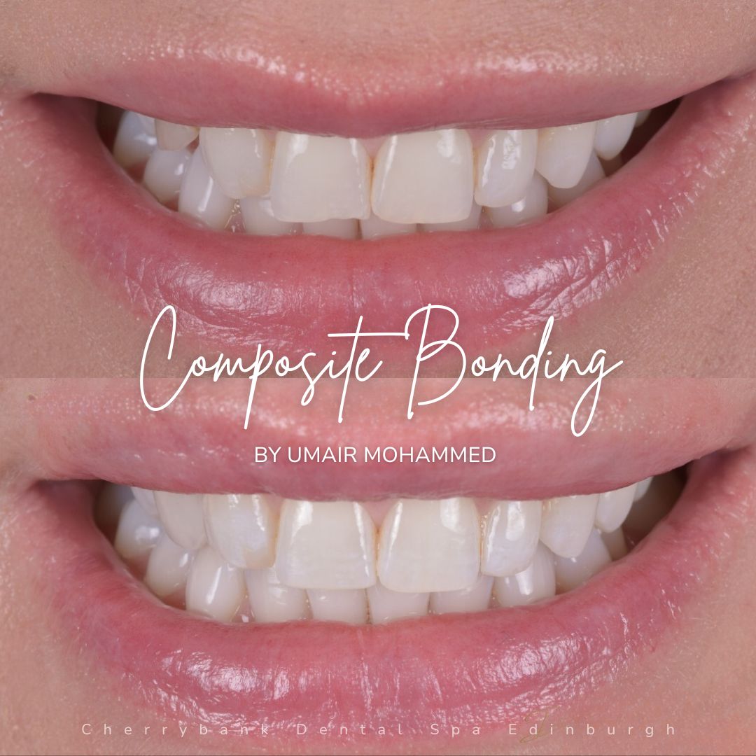 Smile Makeovers in Edinburgh | Cherrybank Dental Spa Edinburgh Before and after treatment at Cherrybank Dental Spa
