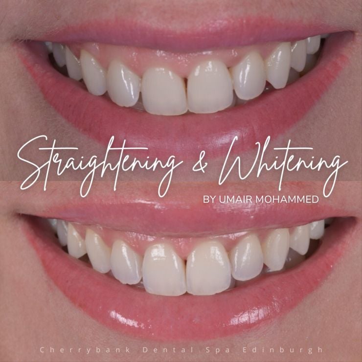Smile Gallery | Cherrybank Dental Spa Edinburgh