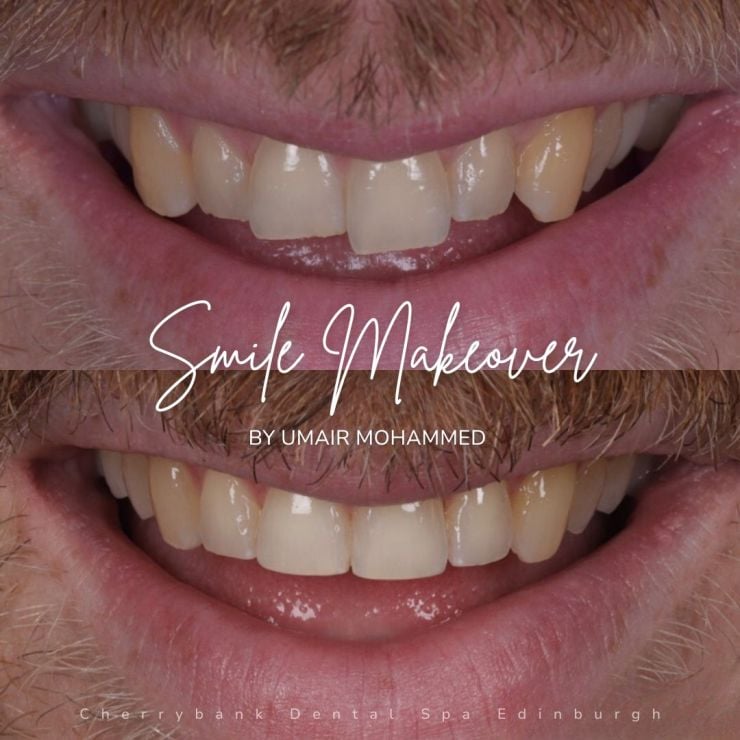 Smile Gallery | Cherrybank Dental Spa Edinburgh