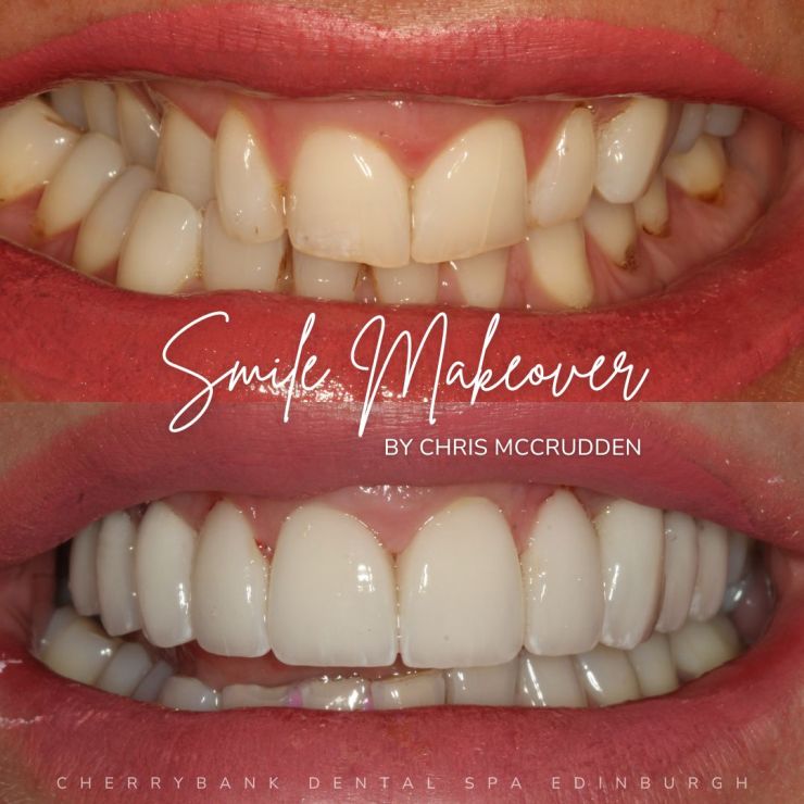 Smile Gallery | Cherrybank Dental Spa Edinburgh