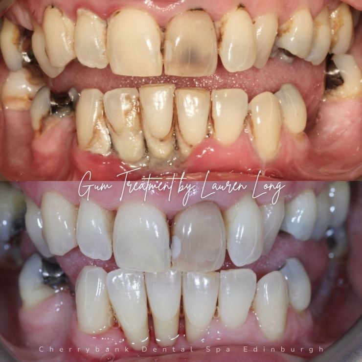 Smile Gallery | Cherrybank Dental Spa Edinburgh
