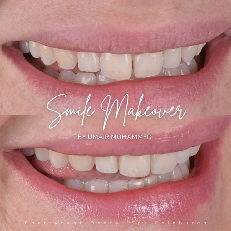 Smile Gallery | Cherrybank Dental Spa Edinburgh