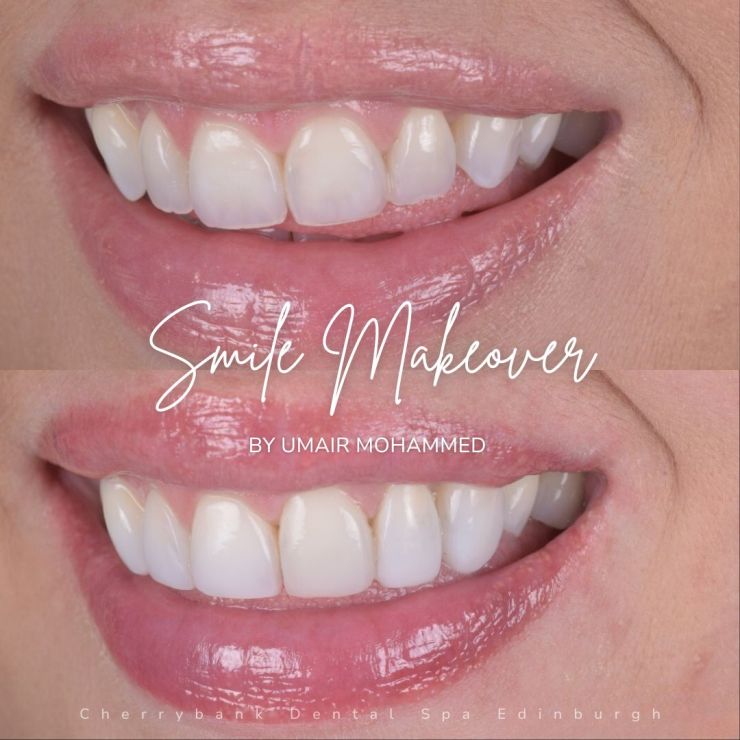Smile Gallery | Cherrybank Dental Spa Edinburgh