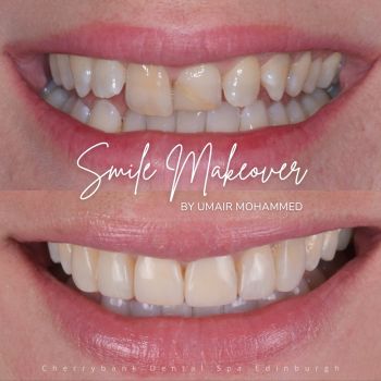 Lisa had Hygiene, Teeth Whitening, Porcelain Veneers and Crowns with Chris