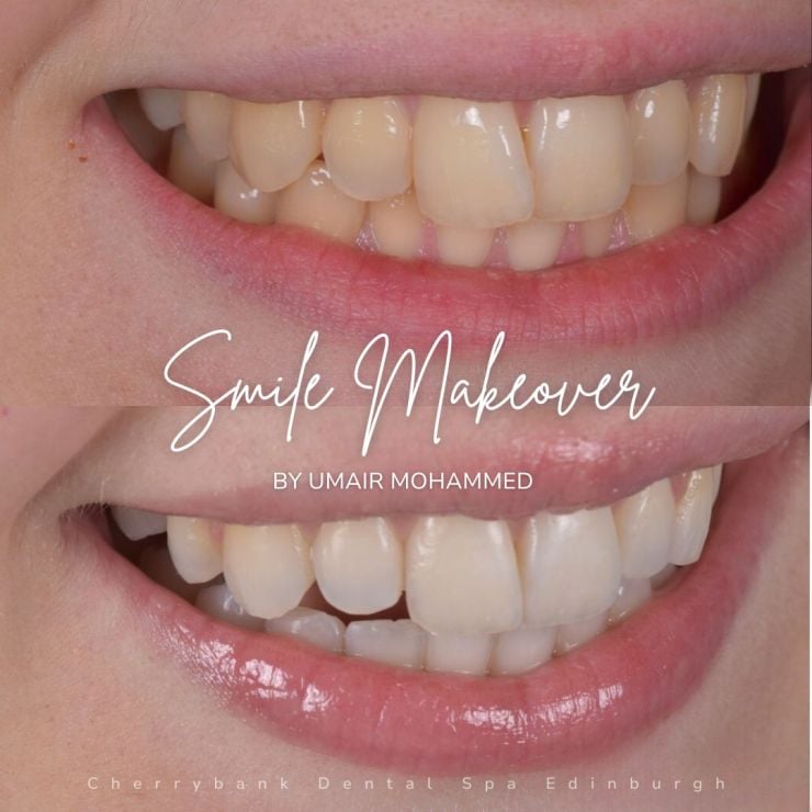 Smile Gallery | Cherrybank Dental Spa Edinburgh