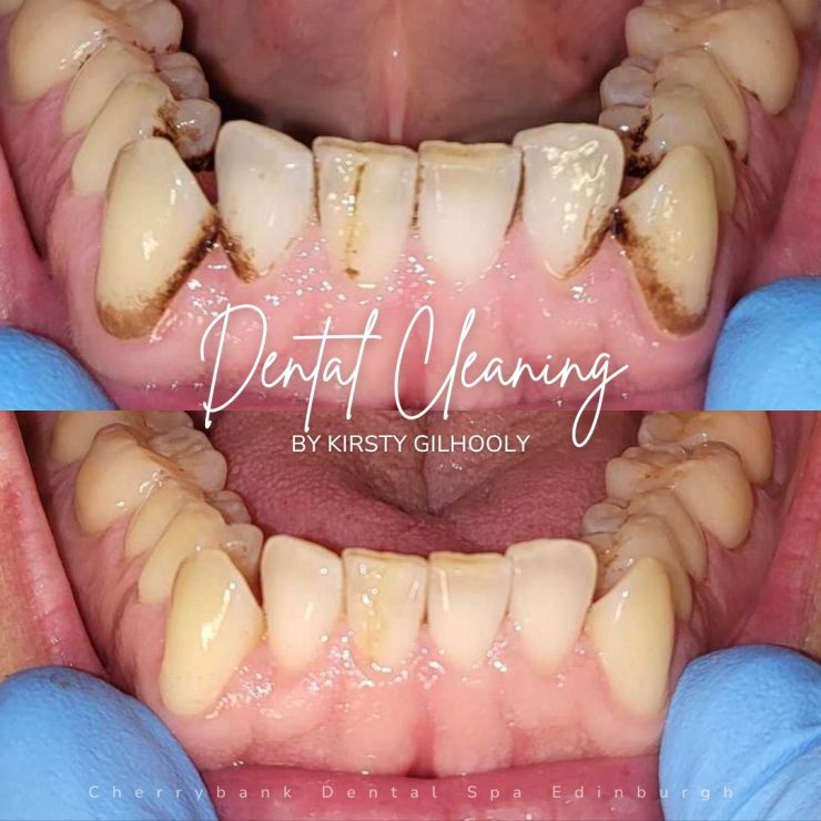 Smile Gallery | Cherrybank Dental Spa Edinburgh