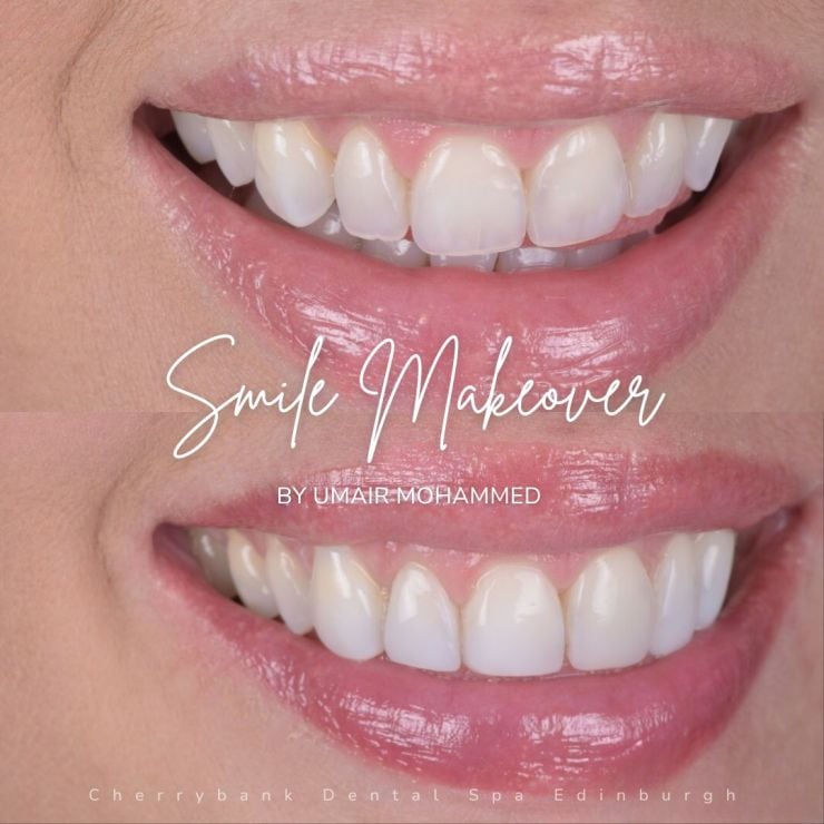 Smile Gallery | Cherrybank Dental Spa Edinburgh