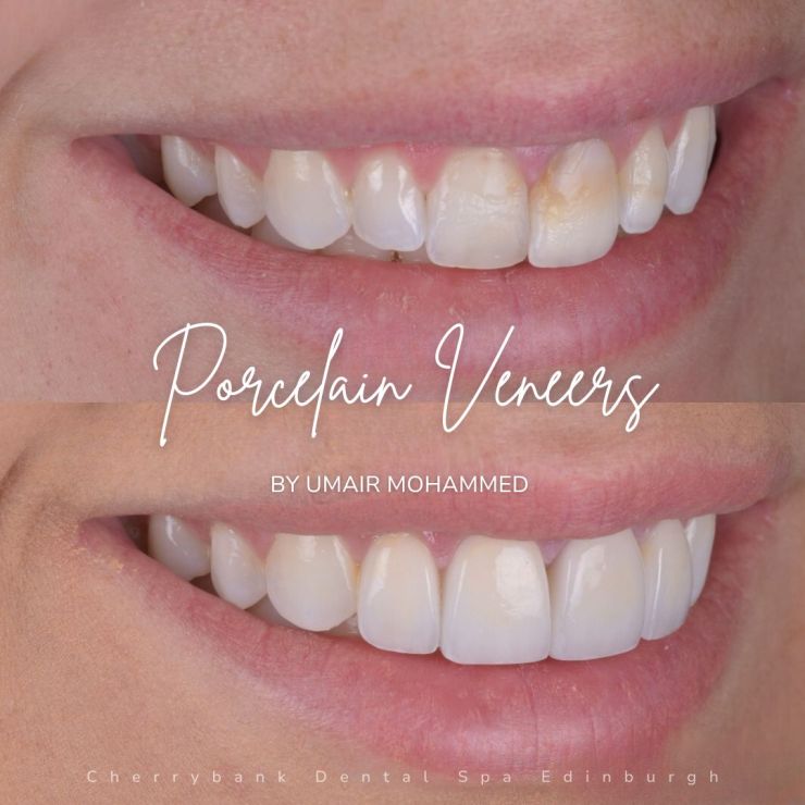 Smile Gallery | Cherrybank Dental Spa Edinburgh