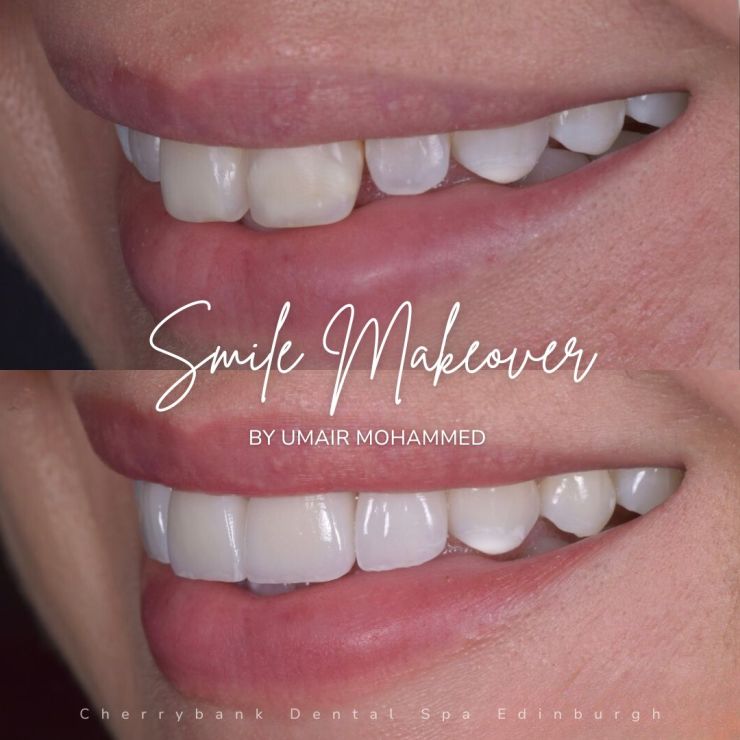 Smile Gallery | Cherrybank Dental Spa Edinburgh